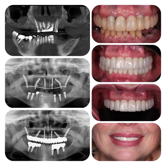 All-on-6 implantation, gum plastic surgery, prosthetics (zirconium crowns)