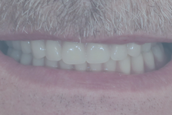 Dental Implants for Periodontal Disease