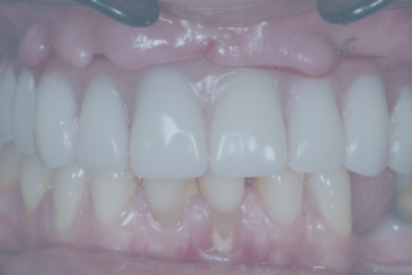All at six: implantation and temporary prosthetics