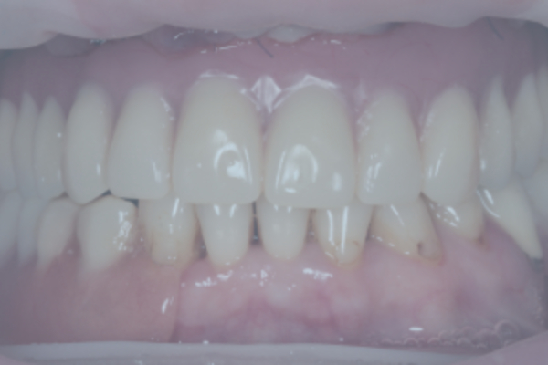All-on-6 and temporary metalacrylic prosthesis