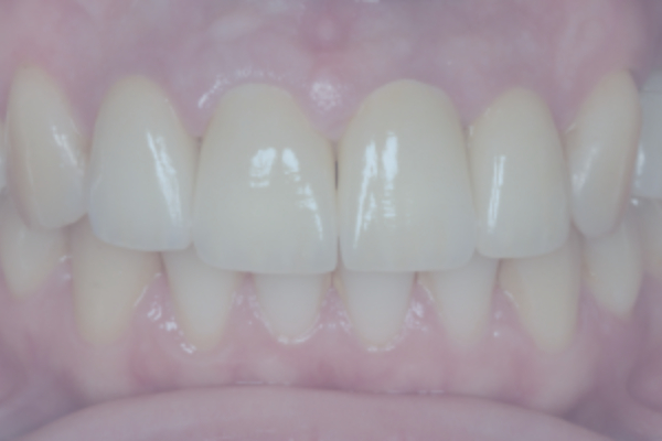 Zirconium crowns instead of composite restorations