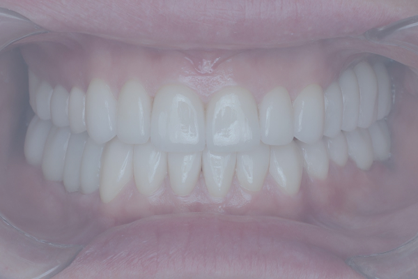 Implantation and prosthetics of teeth in three stages