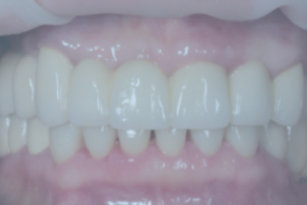 Implant Placement in the Lateral Sectors and Replacement of Old Crowns
