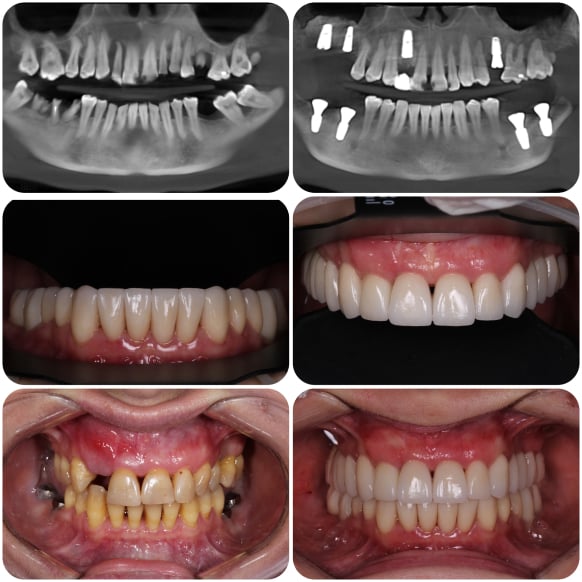 Implantation and prosthetics (veneers)