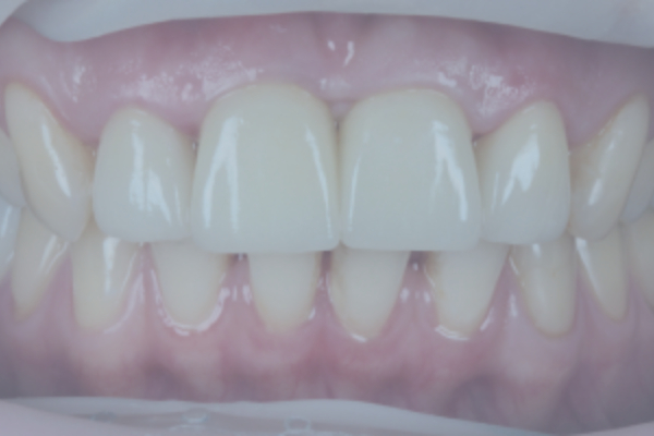 Dental Implants and Prosthetics in the Smile Zone
