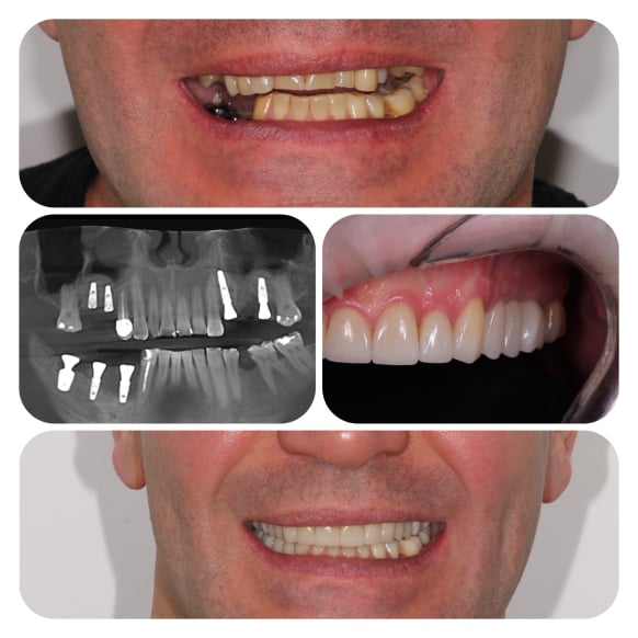 Implantation and prosthetics (veneers and crowns)