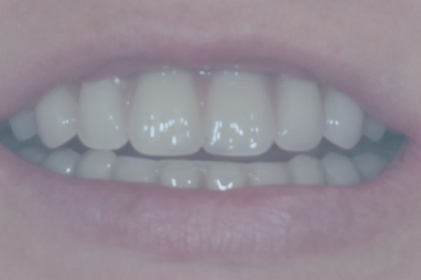 All-on-6 Dental Implants Instead of Removable Dentures
