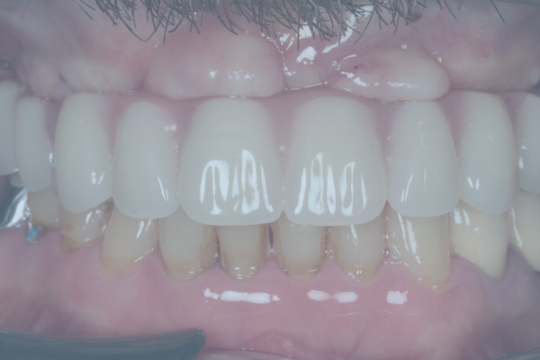Upper Jaw Prosthesis on Six Implants