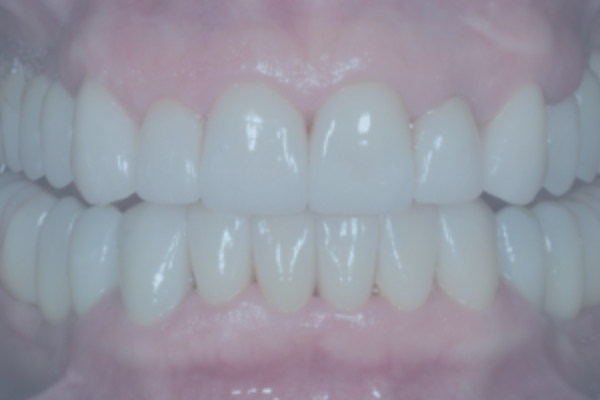E-max Veneers, Zirconia Crowns, and Dental Implants