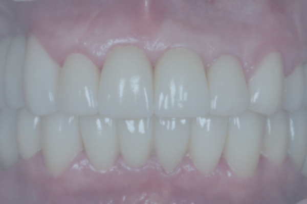 Zirconia Crown Restoration on Implants