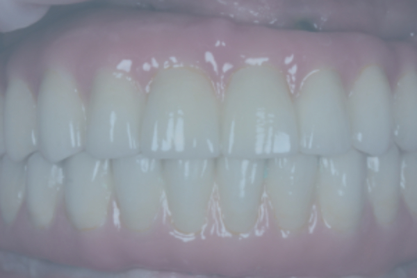 Metal-Ceramic Dental Restorations: "All on Six" Implants