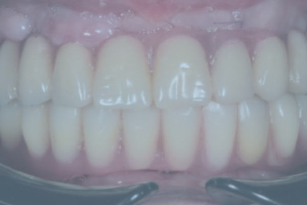 Dental Prosthetics and 