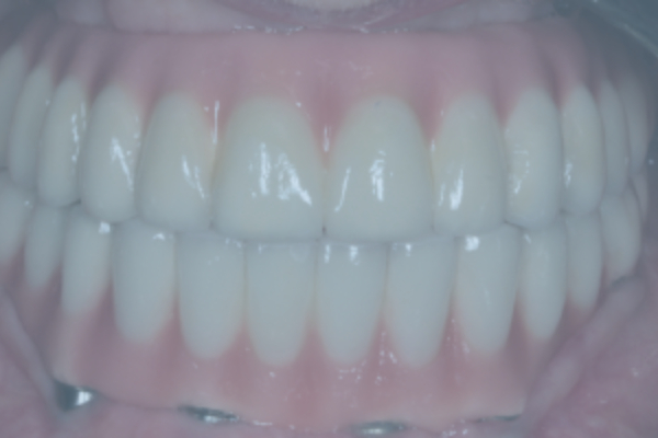 Two-Stage Dental Implant Restoration