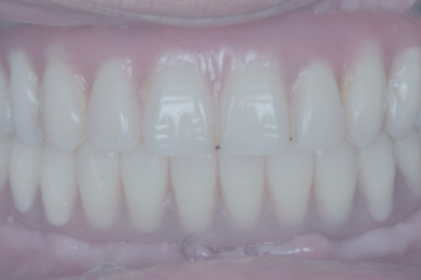 Comprehensive Dental Prosthetics for Both Jaws