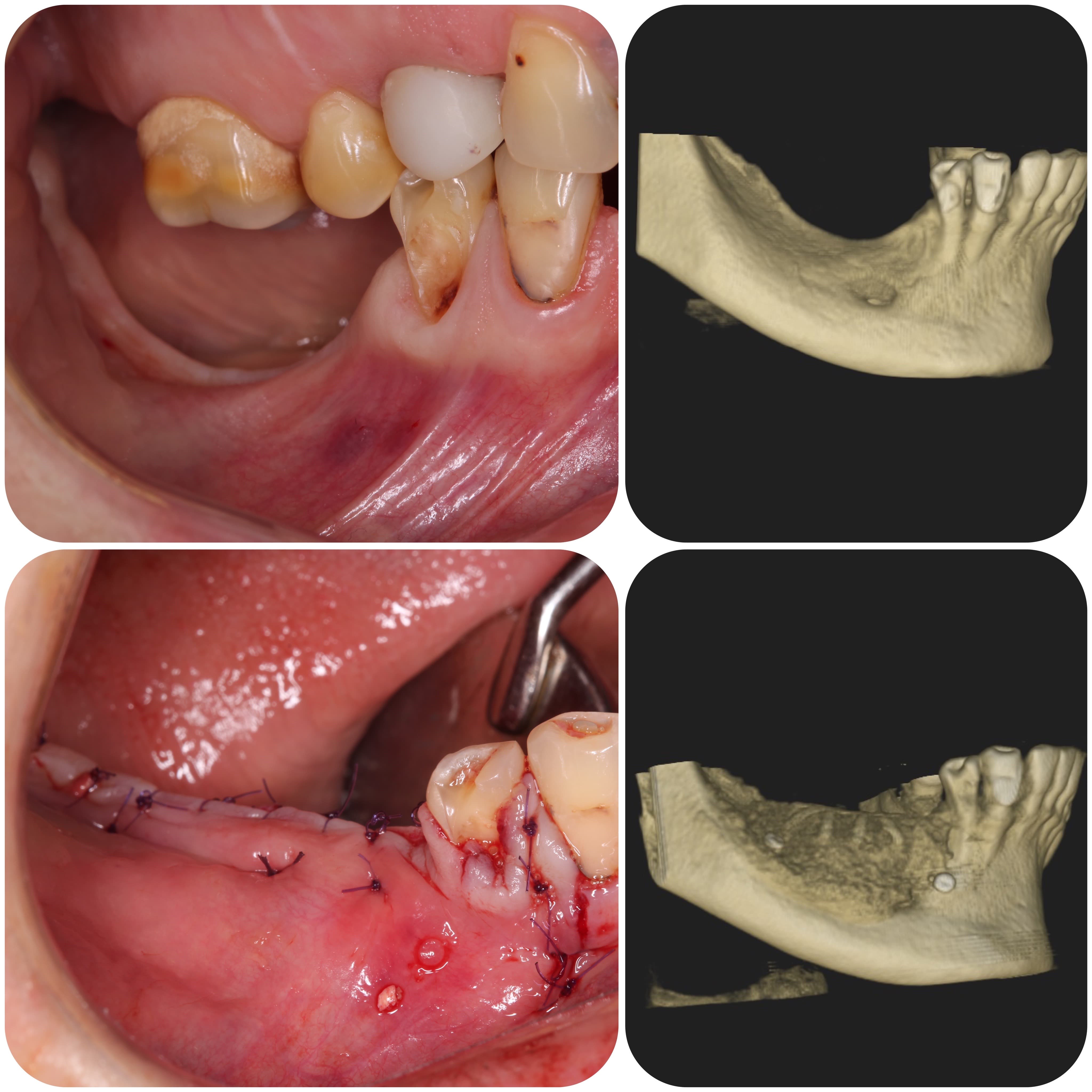 Bone tissue augmentation