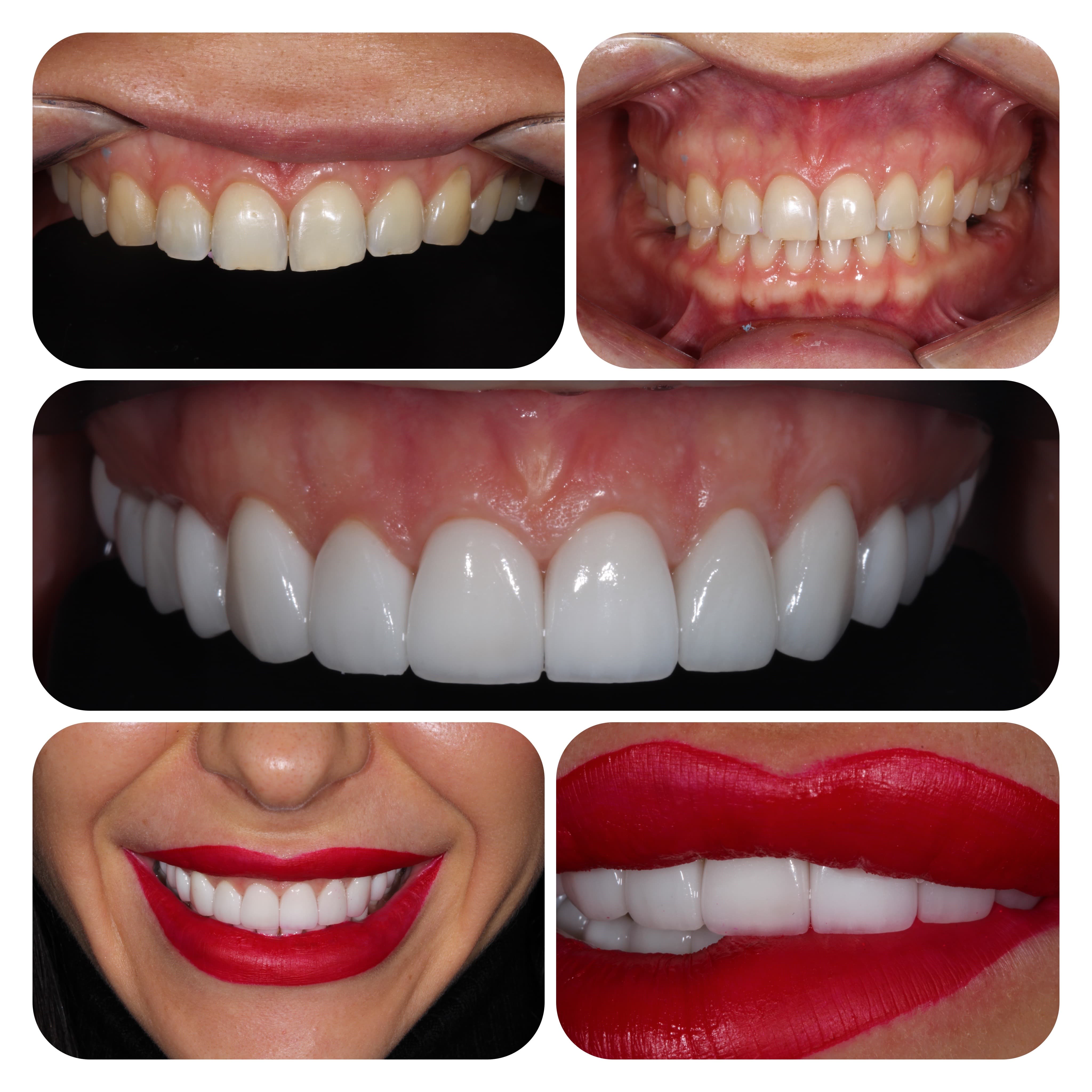 Ceramic veneers