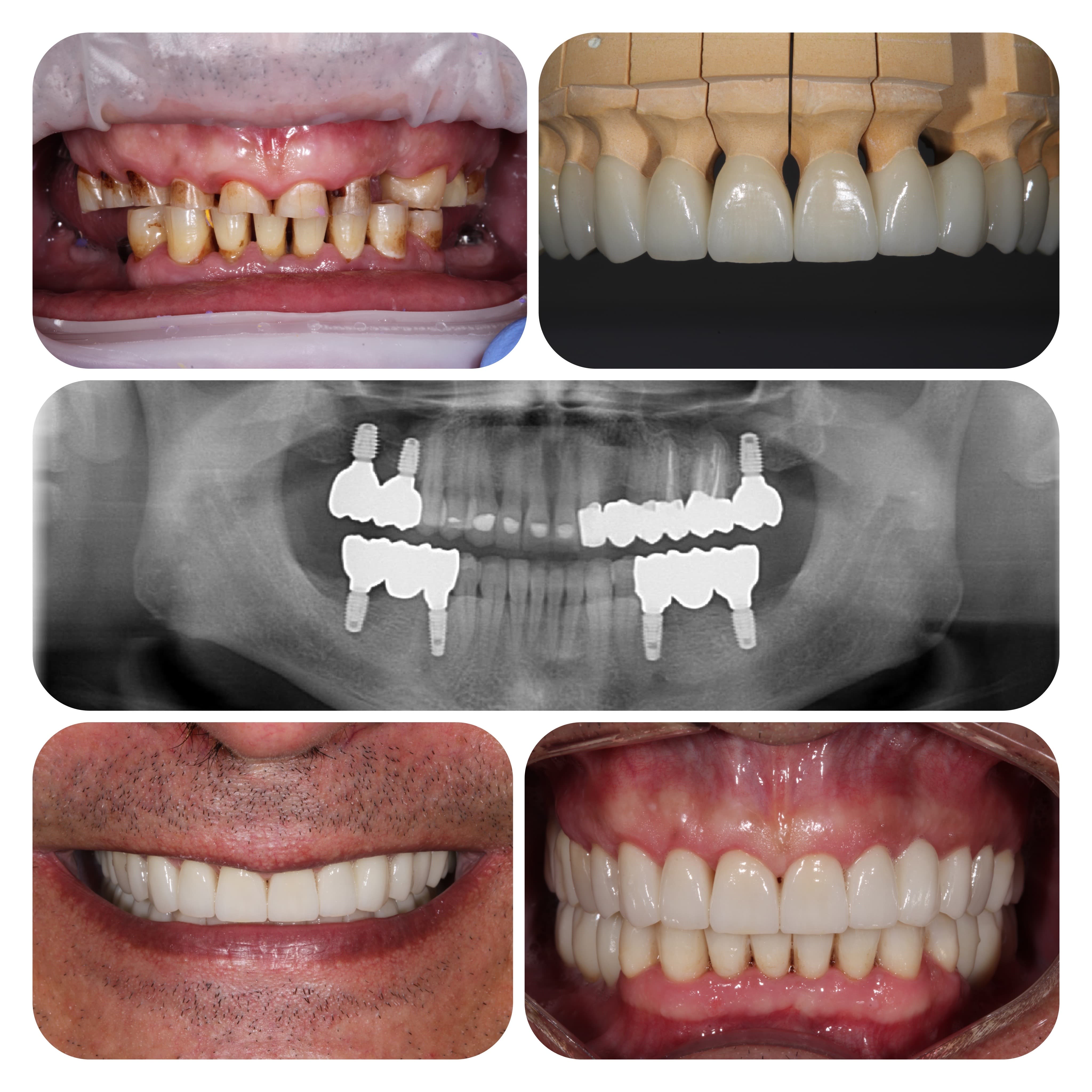 Implantation and prosthetics, bite restoration