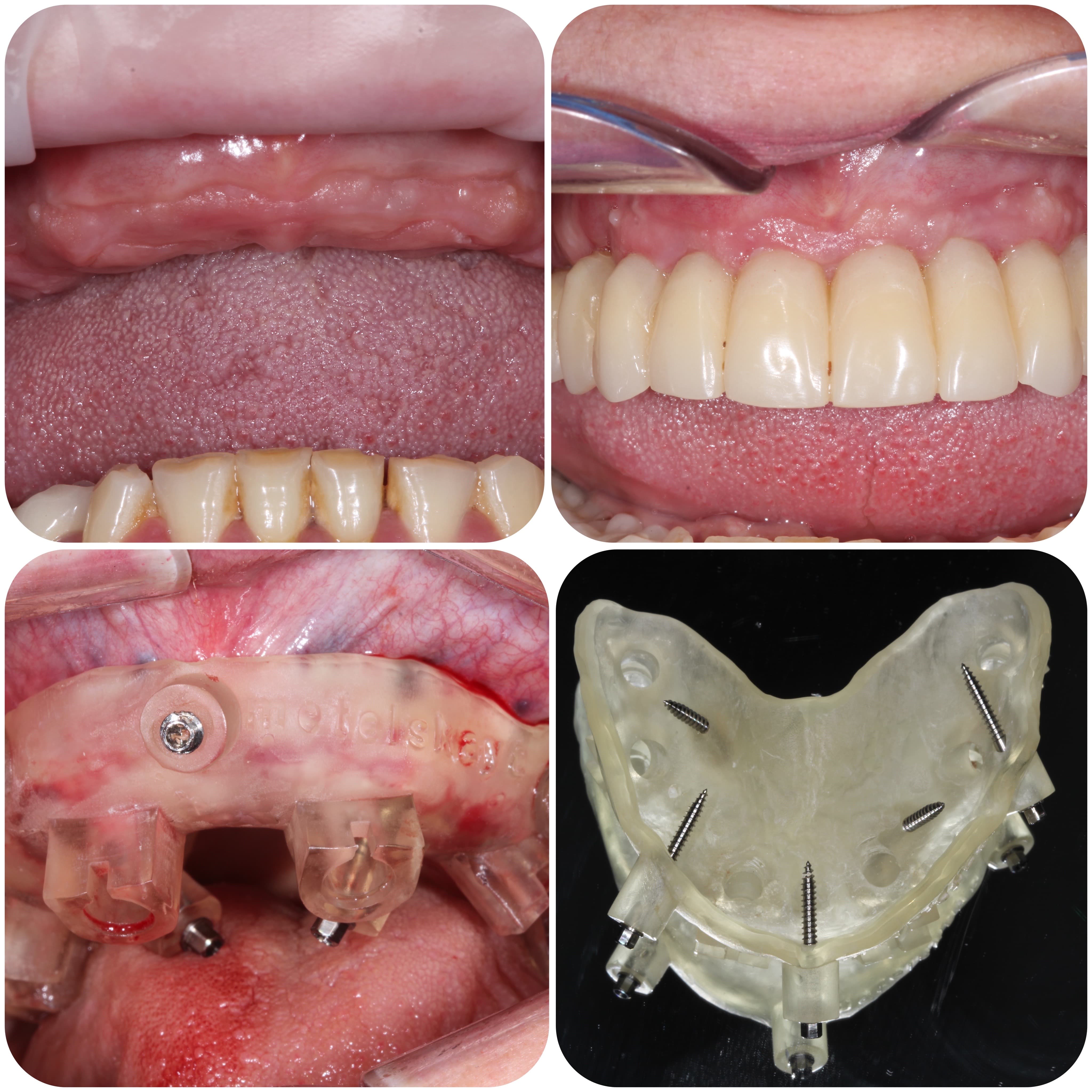 Implantation with surgical template, temporary prosthetics