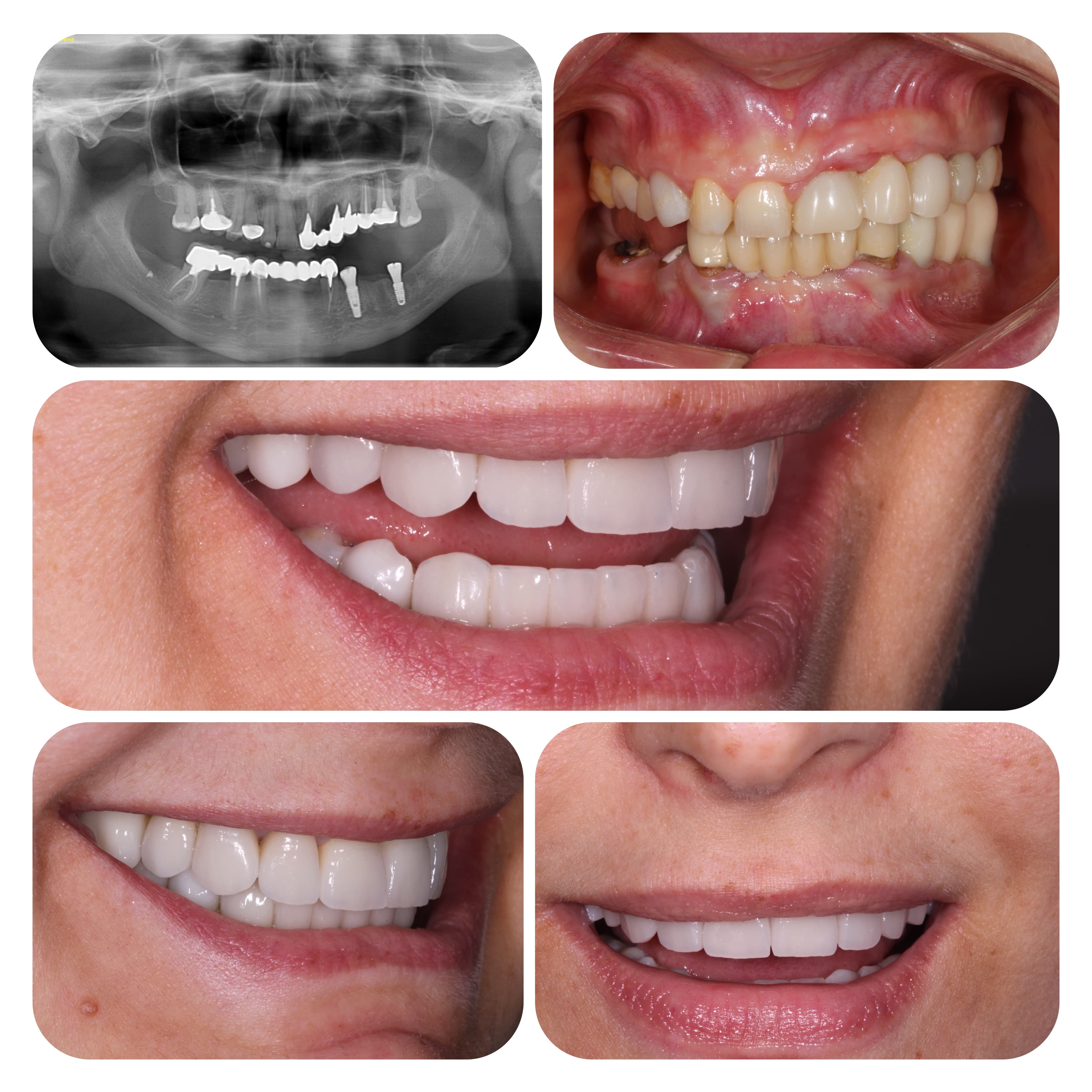 Implantation, replacement of old dentures and prosthetics