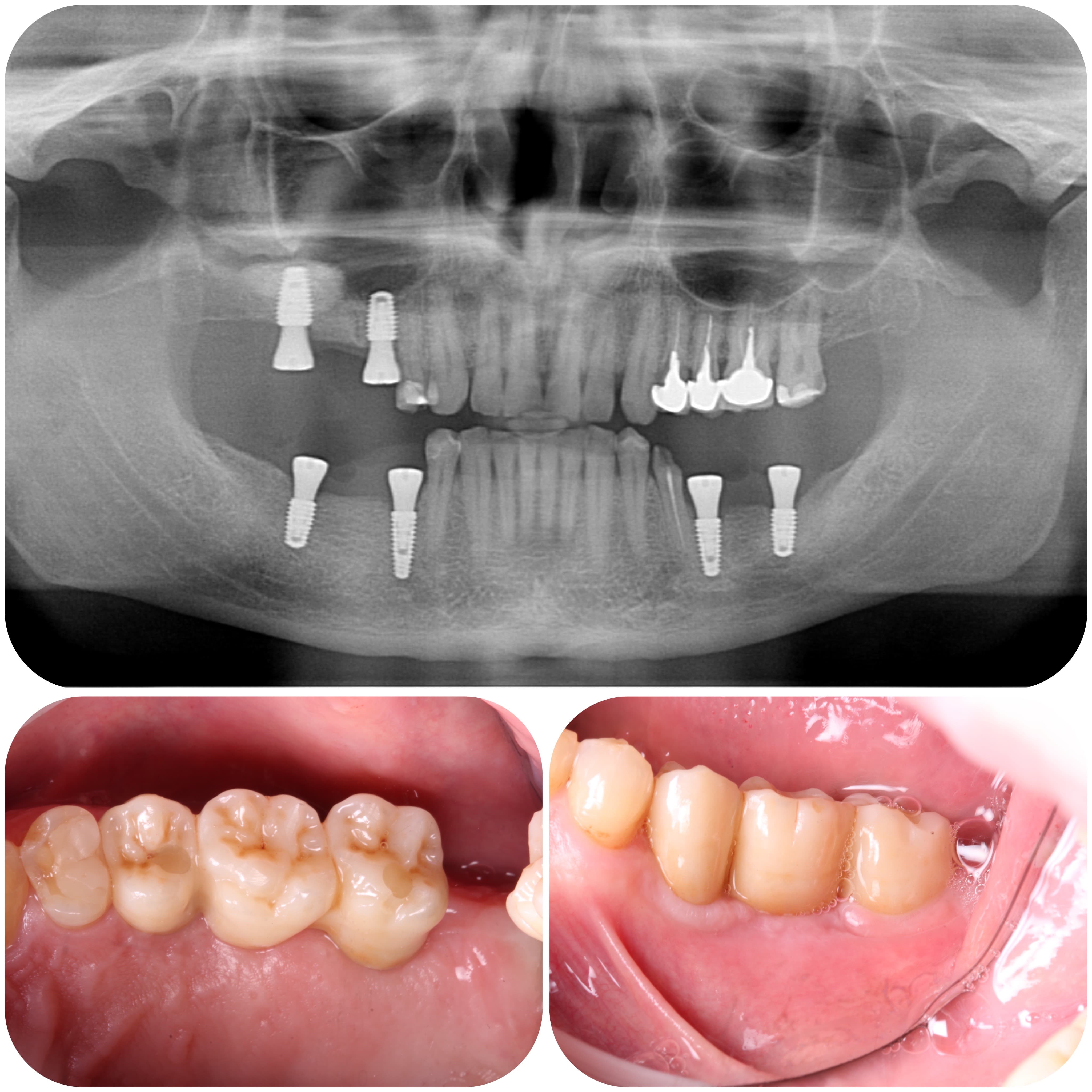 Bridge prosthetics on implants