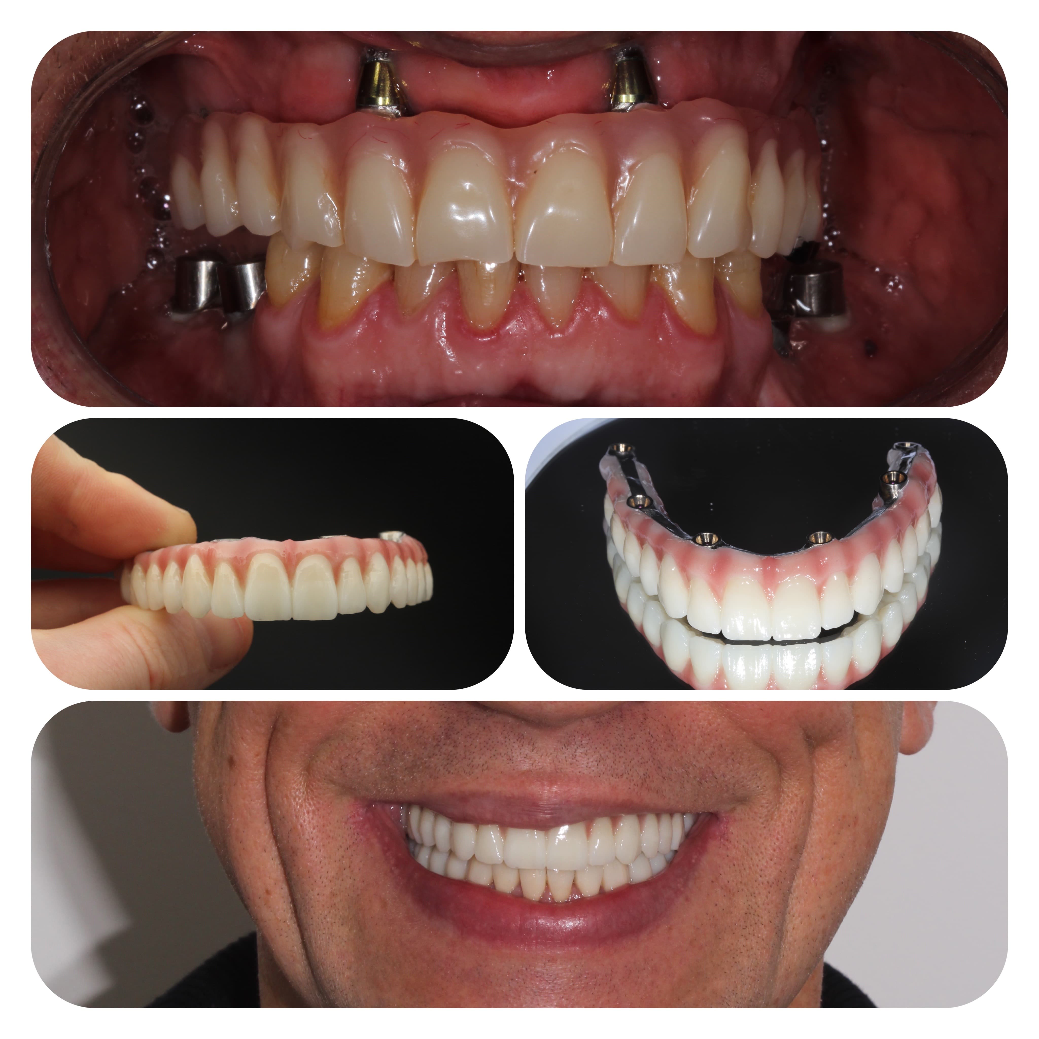 All-on-6 and replacement of temporary dentures with permanent zirconium ones