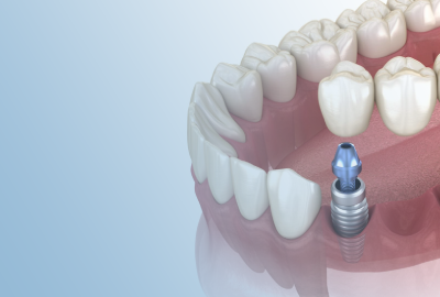 Two-stage implantation