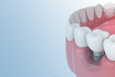 Ceramic crowns