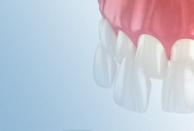 Ceramic veneers