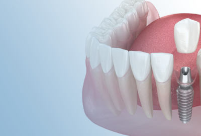 One-stage implantation