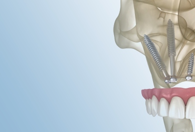 Pterygoid implantation