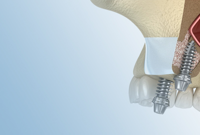 Sinus lift