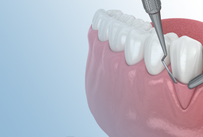 Soft tissues plastic surgery
