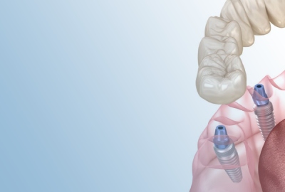 Complex implantation