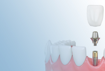 Zirconium crowns