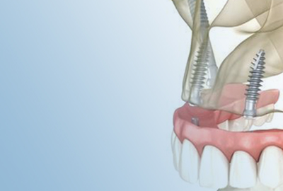 Zygomatic implantation